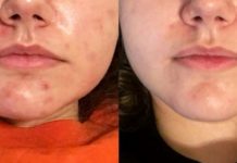 2 კომპონენტიანი აკნეს სამკურნალო საშუალება.