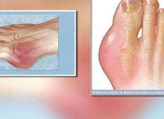 მოიშორეთ შარდმჟავა ამ მეთოდით და დაამარცხეთ ტკივილი სამუდამოდ.