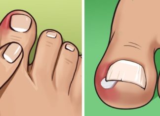 როგორ უნდა უმკურნალოთ ჩაბრუნებულ ფრჩხილს? სასარგებლო და ეფექტური რჩევები