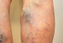 8 წესი, რომელიც უნდა დაიცვათ, თუ ვარიკოზული ვენების განკურნება გსურთ