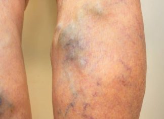 8 წესი, რომელიც უნდა დაიცვათ, თუ ვარიკოზული ვენების განკურნება გსურთ