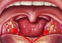 საუკეთესო რეცეფტი ანგინის, სინუსიტისა და სხვადასხვა ინფეციების დროს