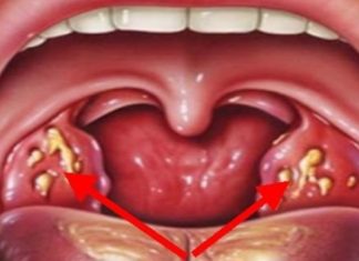 საუკეთესო რეცეფტი ანგინის, სინუსიტისა და სხვადასხვა ინფეციების დროს