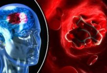 თრომბის სიმპტომები, რომლებიც აუცილებლად უნდა იცოდეთ!