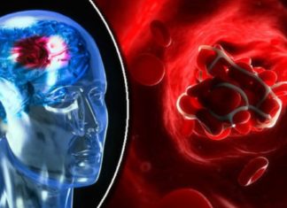 თრომბის სიმპტომები, რომლებიც აუცილებლად უნდა იცოდეთ!