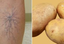 მოიშუშეთ ვენების გაფართოებისგან მოყენებული ტკივილი ამ ინგრედიენტის დახმარებით!