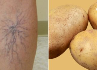 მოიშუშეთ ვენების გაფართოებისგან მოყენებული ტკივილი ამ ინგრედიენტის დახმარებით!