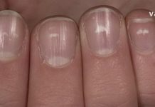 რა იწვეს ფრჩხილებზე თეთრ ლაქებს? 3 რამ, რაც თქვენს ფრჩხილებზე უნდა იცოდეთ