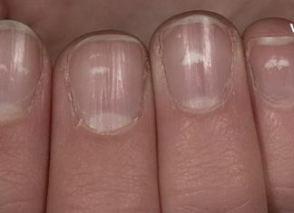 რა იწვეს ფრჩხილებზე თეთრ ლაქებს? 3 რამ, რაც თქვენს ფრჩხილებზე უნდა იცოდეთ