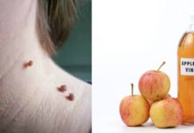 ეს ინგრედიენტი დაგეხმარებათ ხორცმეტის მოშორებაში! უმარტივესია…