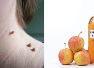 ეს ინგრედიენტი დაგეხმარებათ ხორცმეტის მოშორებაში! უმარტივესია…