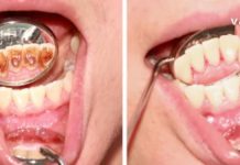 3 ნატურალური ინგრედიენტი კბილის ქვის მოსაშორებლად! ეფექტურია…