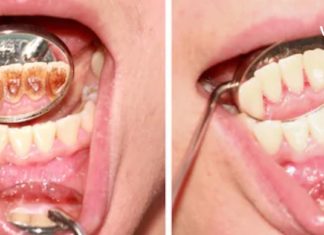 3 ნატურალური ინგრედიენტი კბილის ქვის მოსაშორებლად! ეფექტურია…