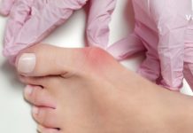 5 ეფექტური მეთოდი პოდაგრას მოსაშორებლად. უბრალოდ სცადეთ!