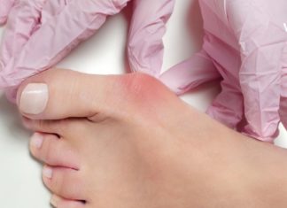 5 ეფექტური მეთოდი პოდაგრას მოსაშორებლად. უბრალოდ სცადეთ!