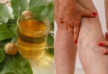 როგორ ვუმკურნალოთ ვენებს? ხალხური მეთოდები, რომელიც ბევრის თქმით ძალიან ეფექტურია!