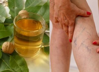 როგორ ვუმკურნალოთ ვენებს?  ხალხური მეთოდები, რომელიც ბევრის თქმით ძალიან ეფექტურია!