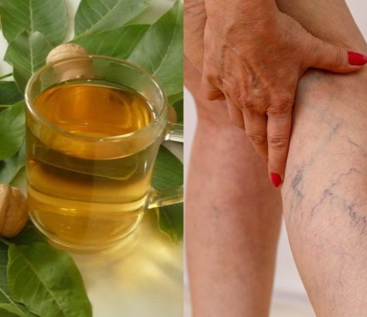 როგორ ვუმკურნალოთ ვენებს? ხალხური მეთოდები, რომელიც ბევრის თქმით ძალიან ეფექტურია!