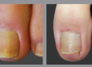 3 ინგრედიენტი, რომელიც ფრჩხილის სოკოს სამუდამოდ დაგავიწყებთ. ყველაზე ეფექტურია