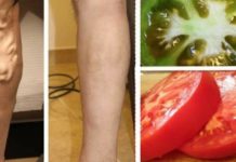 უმკურნალეთ ვენების ვარიკოზულ გაგანიერებას პომიდვრის დახმარებით. ყველაზე ეფექტური მეთოდი