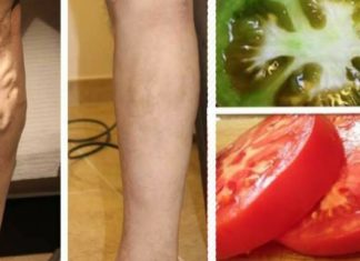 უმკურნალეთ ვენების ვარიკოზულ გაგანიერებას პომიდვრის დახმარებით. ყველაზე ეფექტური მეთოდი