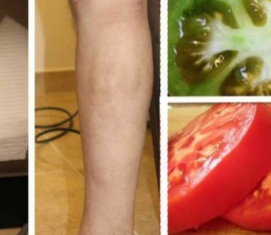 უმკურნალეთ ვენების ვარიკოზულ გაგანიერებას პომიდვრის დახმარებით. ყველაზე ეფექტური მეთოდი