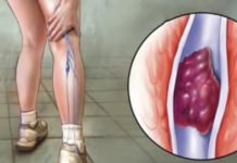 განიკურნეთ ვენების თრომბოზისგან ამ ორი ინგრედიენტის დახმარებით. საოცრად ეფექტურია