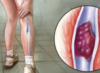 განიკურნეთ ვენების თრომბოზისგან ამ ორი ინგრედიენტის დახმარებით. საოცრად ეფექტურია