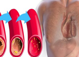 გაისუფთავეთ არტერიები მარტივად- სცადეთ საოცრად  ეფექტური სასმელი