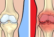 Როგორ გადავარჩინოთ საკუთარი თავი სახსრების მტანჯველი ტკივილისგან?