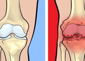 Როგორ გადავარჩინოთ საკუთარი  თავი სახსრების მტანჯველი ტკივილისგან?