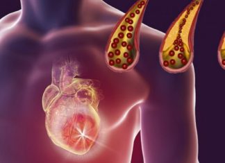 სისხლძარღვების წმენდა ამ მეთოდებით ყველაზე ეფექტურია. გაეცანით რეცეპტებს!