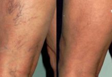 წამალი, რომელიც ათავისუფლებს ვარიკოზულ ვენებს – მხოლოდ 1 პროდუქტი და 15 წუთი