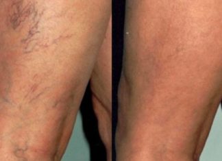 წამალი, რომელიც ათავისუფლებს ვარიკოზულ ვენებს – მხოლოდ 1 პროდუქტი და 15 წუთი