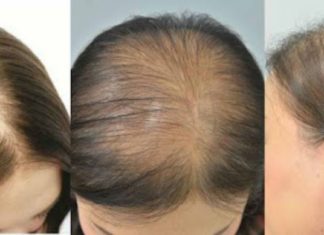 თმის ცვენა აღარ შეგაწუხებთ, თუ სახლში ამ ნიღაბს მოამზადებთ. აუცილებლად სცადეთ!