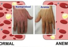 ანემიის სიმპტომები და მისი მკურნალობის ეფექტური გზები. ეს მნიშვნელოვანია!