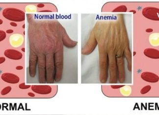 ანემიის სიმპტომები და მისი მკურნალობის ეფექტური გზები. ეს მნიშვნელოვანია!