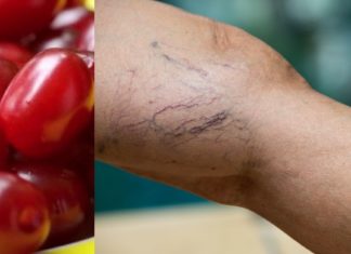 როგორ უნდა უმკურნალოთ ვარიკოზულ ვენებს და ფეხების შეშუპებას შინდის დახმარებით? გთავაზობთ რეცეპტს