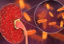 პიელონეფრიტის მკურნალობა სახლის პირობებში შესაძლებელია