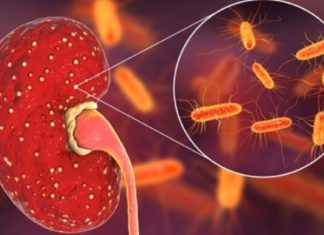 პიელონეფრიტის მკურნალობა სახლის პირობებში შესაძლებელია