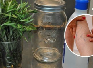 მოამზადეთ როზმარინის და სპირტის ნაყენი, რომ სამუდამოდ გათავისუფლდეთ ვარიკოზული ვენებისგან