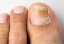 Სოკოთი გამოწვეული ტანჯვა: როგორ გავუმკლავდეთ ამ პრობლემას გარედან და შიგნიდან?!