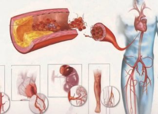 მცენარეებზე უარს ნუ იტყვით ათეროსკლეროზის დროს – თუ თქვენ ათეროსკლეროზის მსხვერპლი ხართ მოკალათდით და დაიწყეთ კითხვა