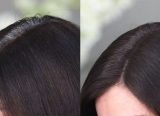 მოიშორეთ ჭაღარა თმა ჭინჭრის დახმარებით. ეფექტური საშუალებაა!