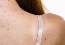 ზურგზე გამონაყარი გაწუხებთ? გამოიყენეთ ეს ბუნებრივი საშუალებები და სამუდამოდ დაივიწყეთ ეს პრობლემა