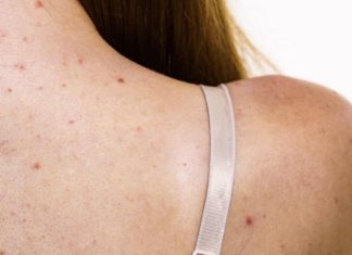 ზურგზე გამონაყარი გაწუხებთ? გამოიყენეთ ეს ბუნებრივი საშუალებები და სამუდამოდ დაივიწყეთ ეს პრობლემა