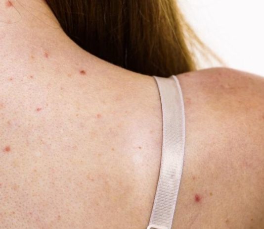 ზურგზე გამონაყარი გაწუხებთ? გამოიყენეთ ეს ბუნებრივი საშუალებები და სამუდამოდ დაივიწყეთ ეს პრობლემა