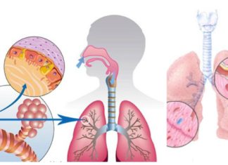 ქრონიკული ბრონქიტი დამეთანხმებით როგორი რთული მდგომარეობაა. ბევრი ტანჯვა გავიარე, მაგრამ ბოლოს გავიმარჯვე.