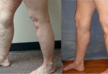 შესანიშნავი სამკურნალო რეცეპტები გაგანიერებული ვენებისთვის