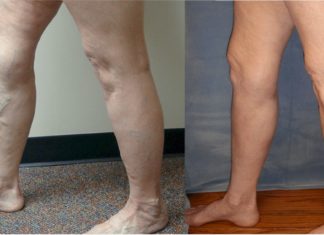 შესანიშნავი სამკურნალო რეცეპტები გაგანიერებული ვენებისთვის